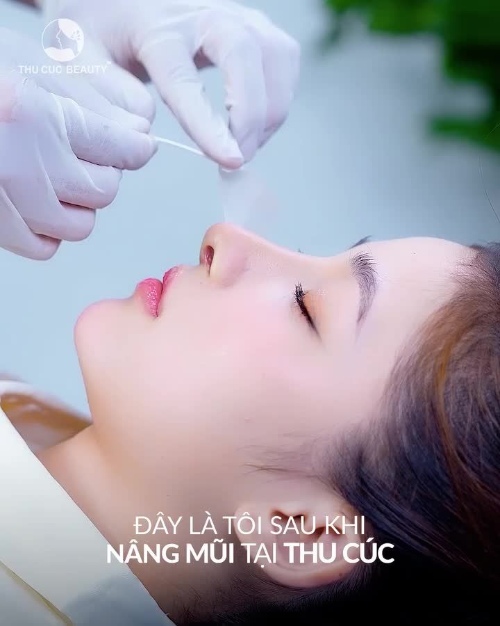 Xóa sổ sống mũi thấp, cánh mũi to bè Sở hữu dáng S-line mềm mại sau 30P với Mũi TC