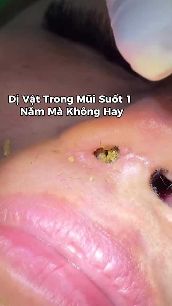 CA GẮP DỊ VẬT Ở TRONG MŨI SUỐT 1 NĂM