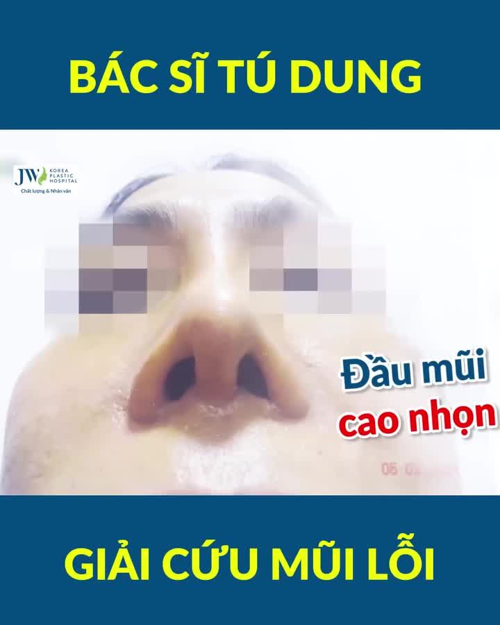 TÁI TẠO MŨI LỖI - NHAN SẮC THAY ĐỔI