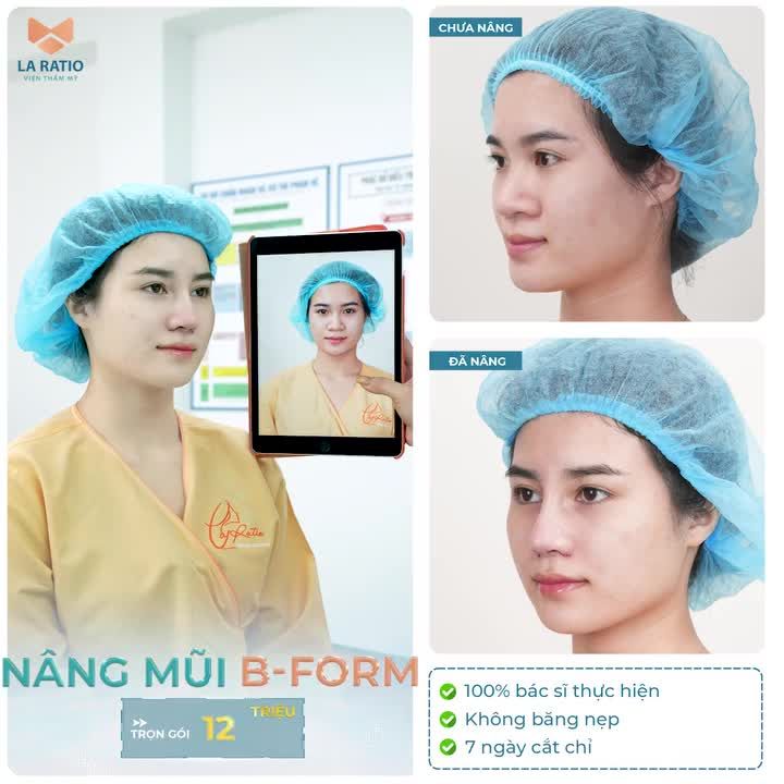 Mũi đẹp ngay sau 45 phút thực hiện