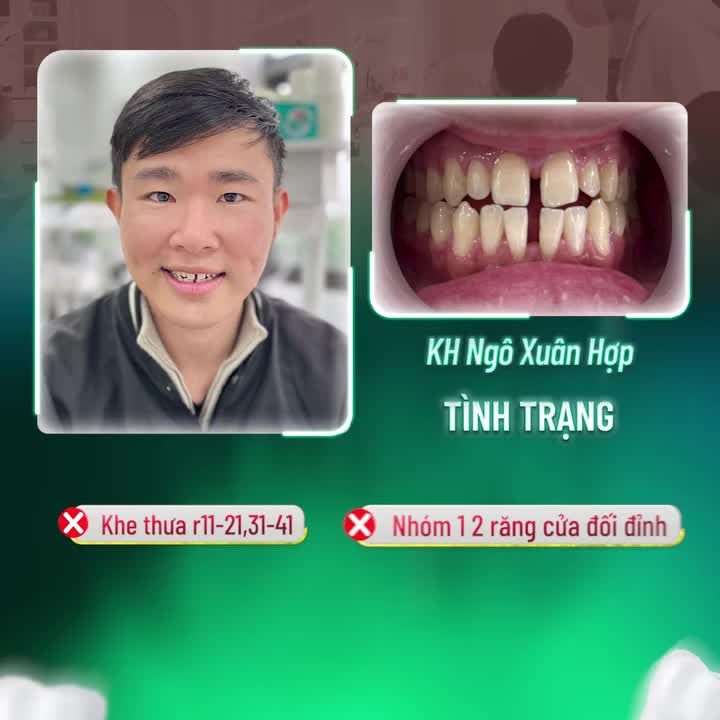 THẨM MỸ RĂNG SỨ GIẢI PHÁP CHO HÀM RĂNG THƯA KẼ
