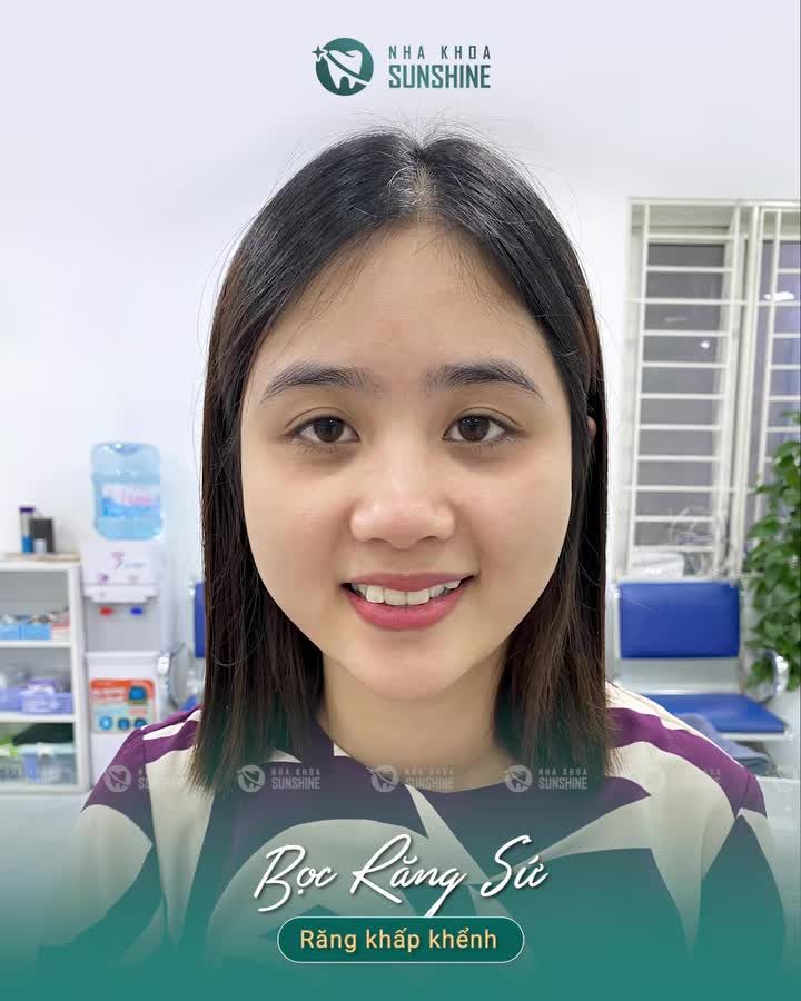 NÂNG TẦM NỤ CƯỜI VỚI BỌC RĂNG SỨ THẨM MỸ