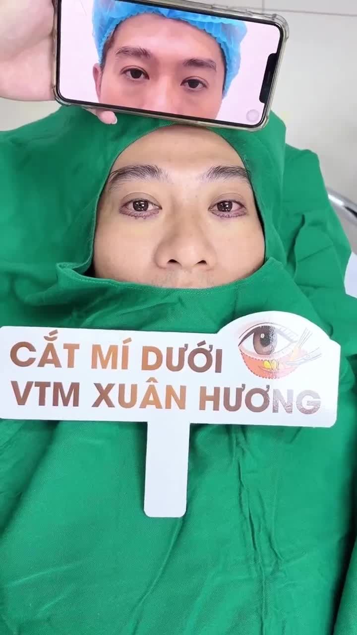 Hết m.ỡ thừa, da mí dưới căng phẳng, trẻ trung hơn ... là hiệu quả mang lại sau khi thực hiện Cắt mí dưới tại Xuân Hương