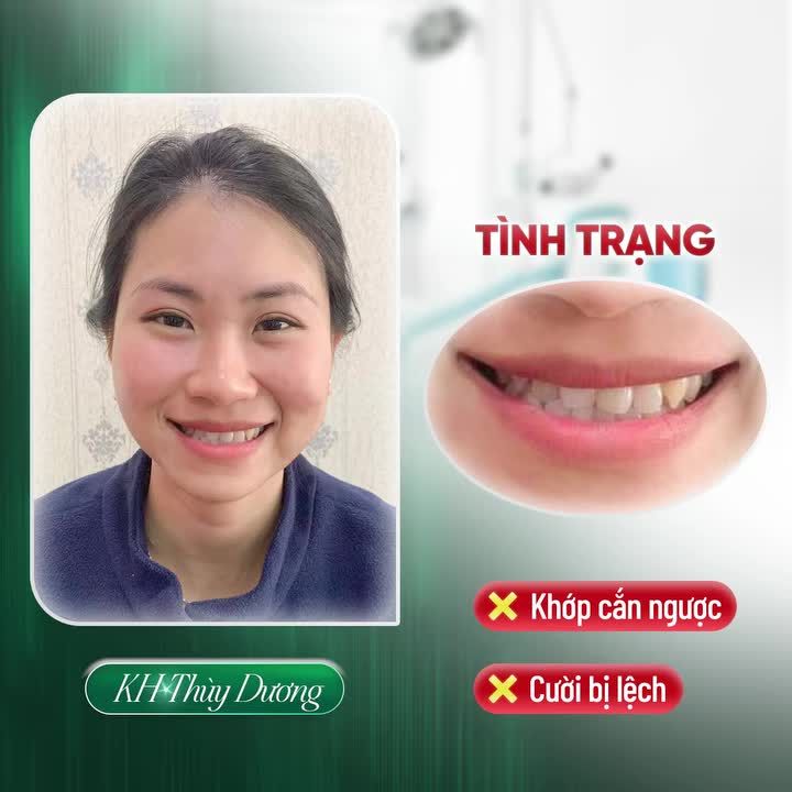 TỰ TIN LUNG LING CÙNG THÙY DƯƠNG SAU KHI THÁO NIỀNG TẠI NHA KHOA GIA ĐÌNH