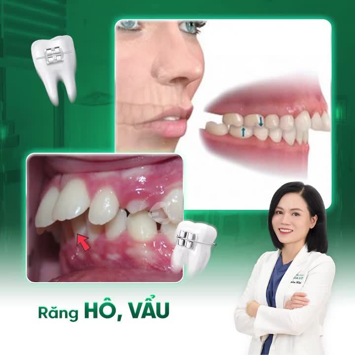 NHỮNG TRƯỜNG HỢP NÊN NIỀNG RĂNG - HÃY ĐỂ NHA KHOA GIA ĐÌNH GIÚP BẠN TỰ TIN VỚI NỤ CƯỜI CỦA MÌNH!!!