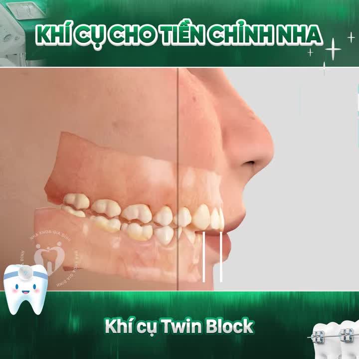 CHỈNH NHA TĂNG TRƯỞNG CÙNG HÀM CHỨC NĂNG TWINBLOCK