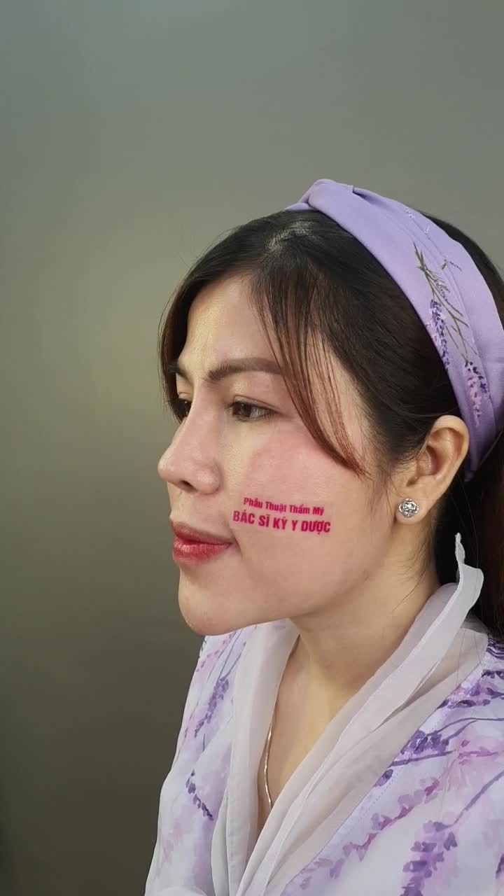 Tái khám sau 13 ngày Độn cằm và sau 5 năm Nâng mũi ALINE của chị khách đến từ Vùng Tàu