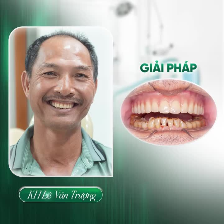 HÀNH TRÌNH TÌM LẠI NỤ CƯỜI CỦA CHÚ LÊ VĂN TRƯỢNG VỚI IMPLANT ALL-ON-6