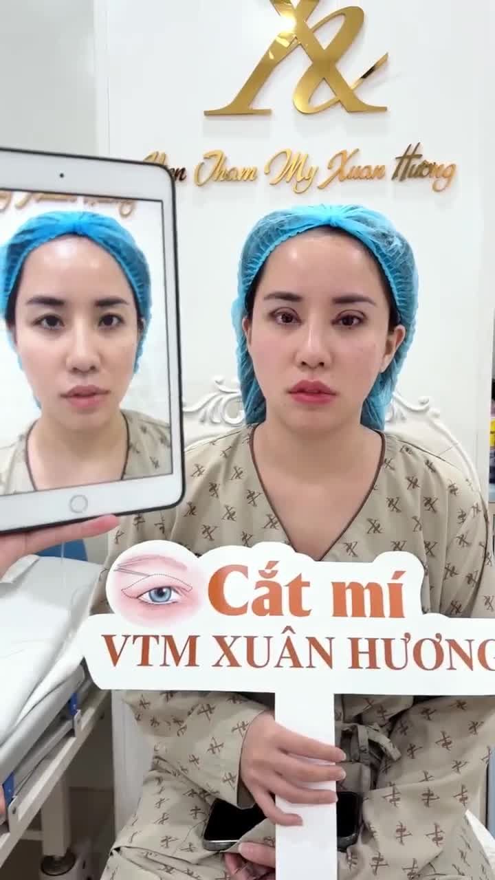 Kết quả sau thực hiện combo cắt mí trên kết hợp mở góc mắt trong