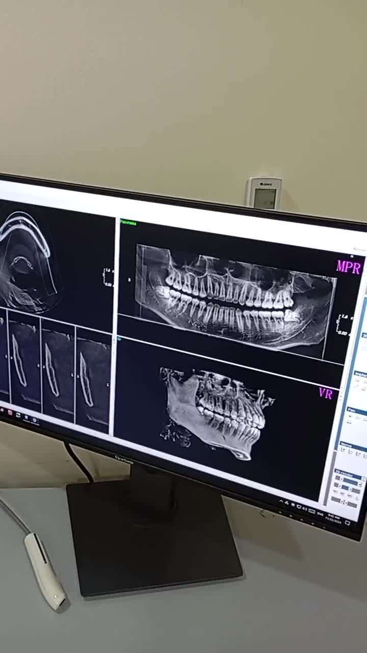 Phân tích ảnh phim trước khi nhổ răng khôn tại cơ sở 29 Nguyễn Du