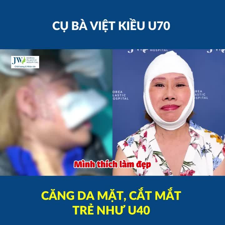 TRẦM TRỒ siêu phẩm CĂNG DA MẶT, CẮT MẮT cho Cụ bà Việt kiều U70 HẾT GIÀ NUA trẻ như U40