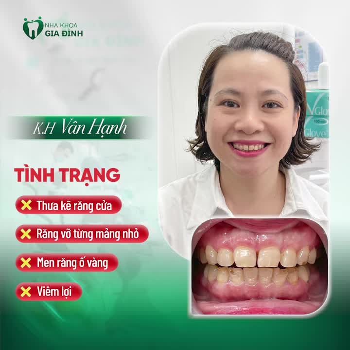 HÀNH TRÌNH TÌM LẠI SỰ TỰ TIN CỦA CHỊ VÂN HẠNH SAU KHI THẨM MỸ RĂNG SỨ TẠI NHA KHOA GIA ĐÌNH