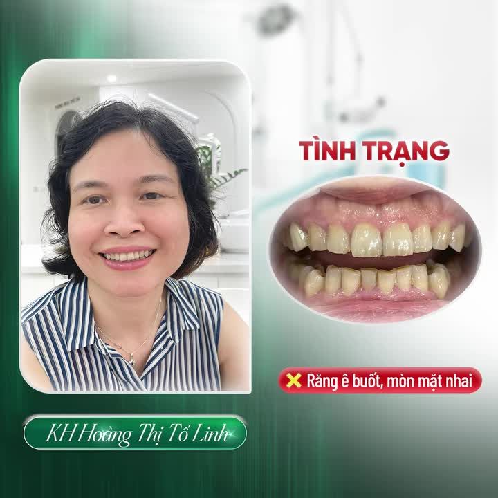 THẨM MỸ RĂNG SỨ - TÂN TRANG LẠI NỤ CƯỜI RẠNG RỠ