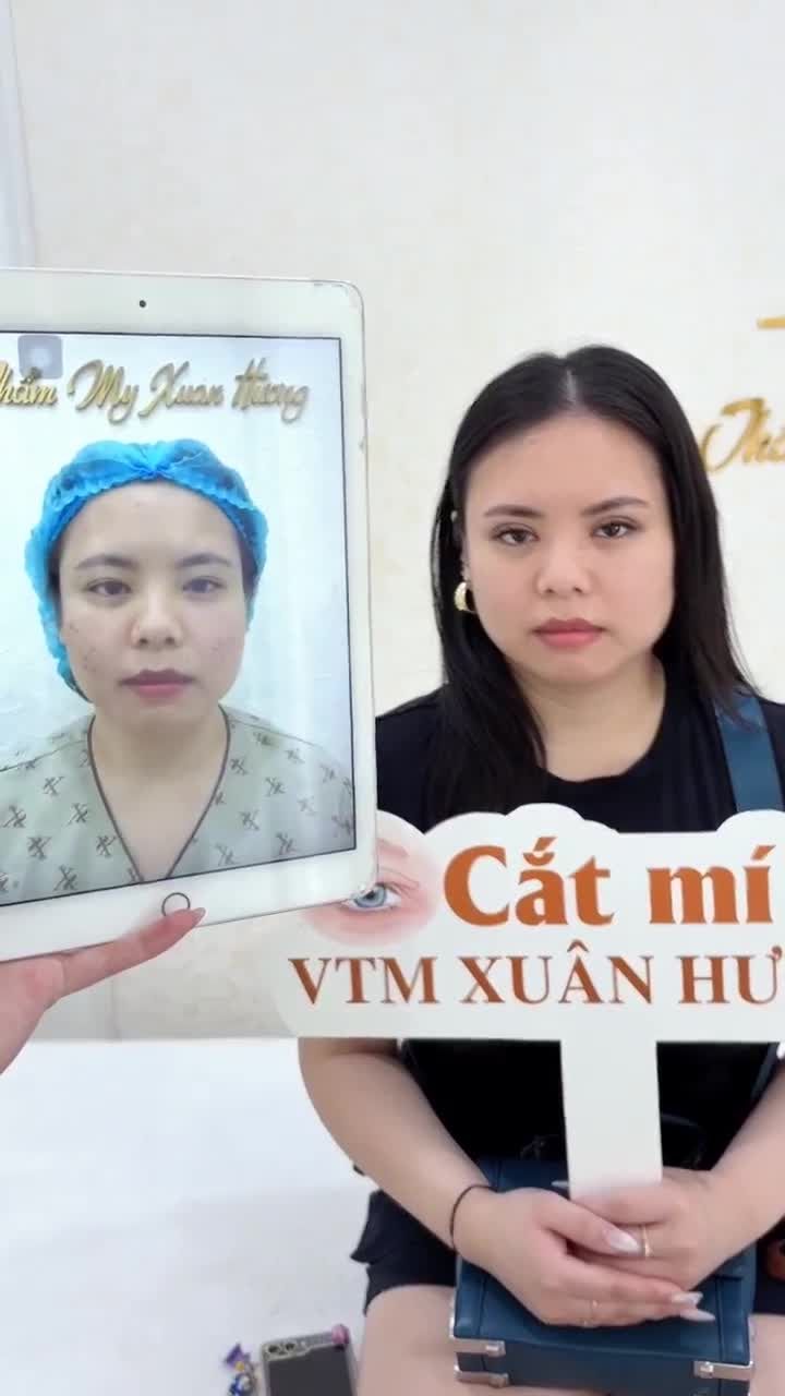 Cùng gặp gỡ khách hàng Việt kiều thăm khám sau cắt mí tại VTM Xuân Hương 20 ngày sẽ như thế nào nhé?