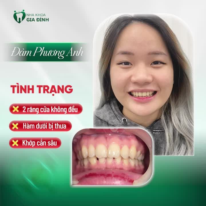 NIỀNG RĂNG XINH - TỰ TIN LUNG LINH