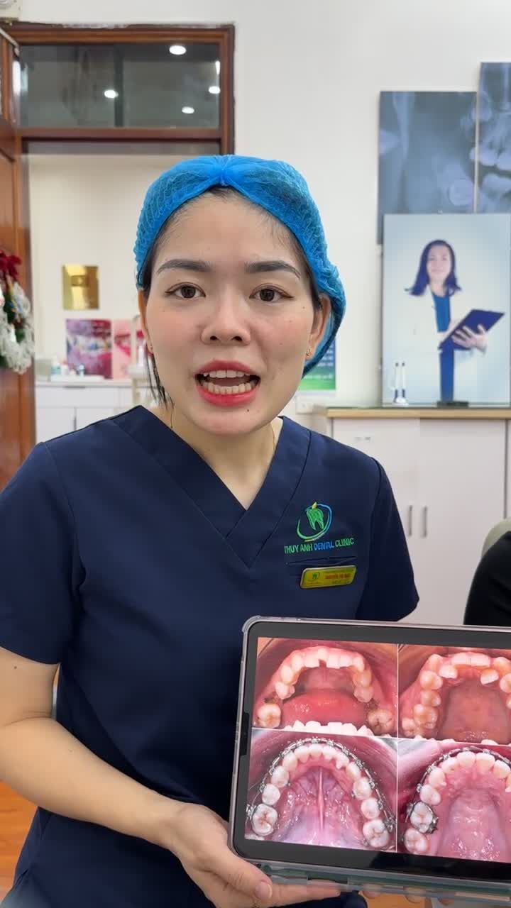 Ca tháo mắc cài kết thúc quá trình chỉnh nha cho bạn Thảo Lan tại Nha Khoa Thuỳ Anh