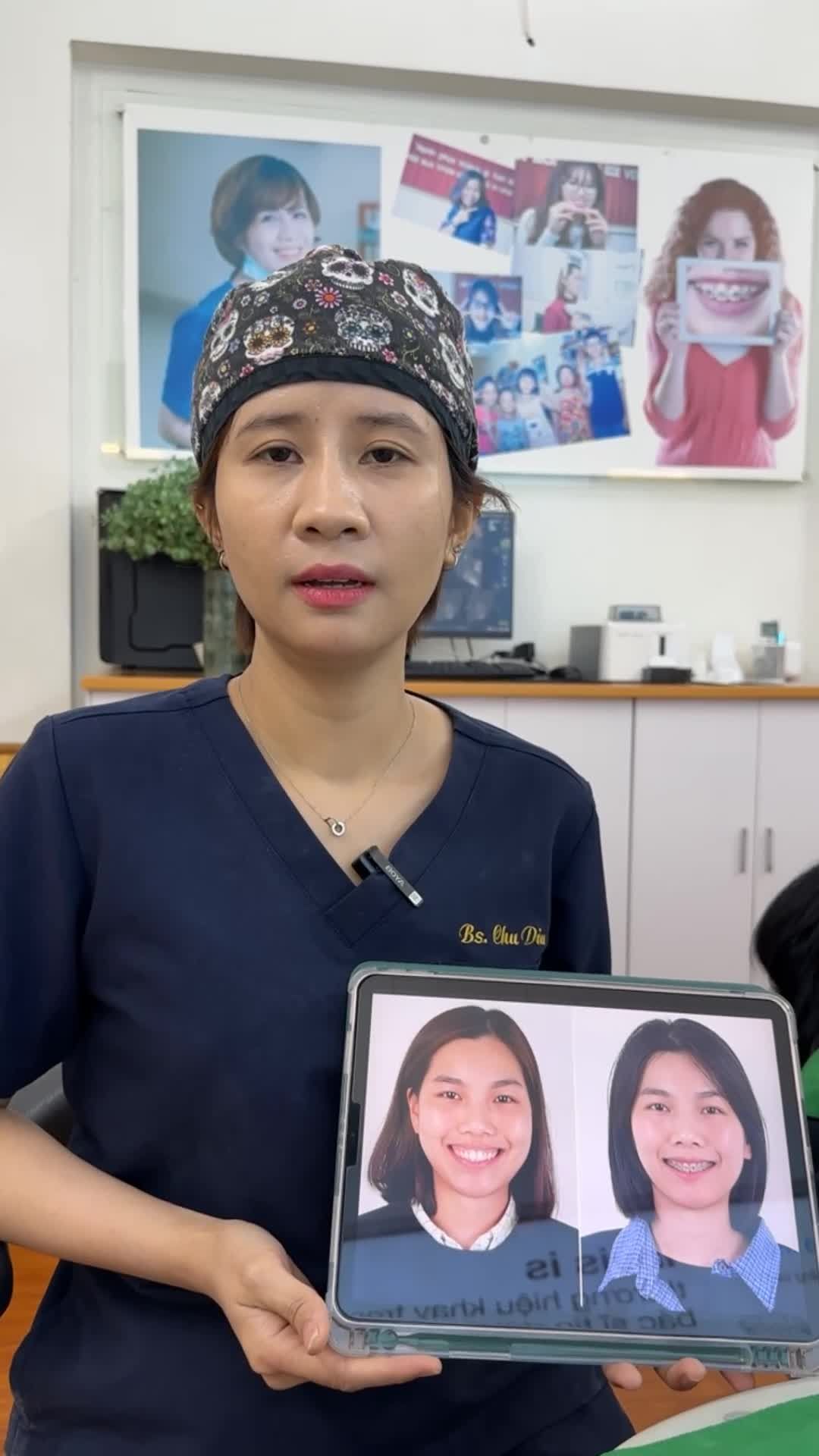 ca tháo mắc cài kết thúc quá trình niềng răng cho bạn Chung Phương gặp tình trạng hô, khấp khểnh