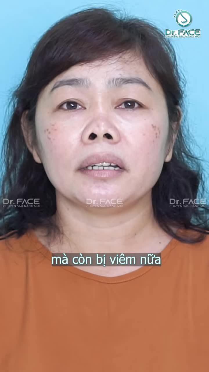 10 NĂM mặc cảm vì mũi "KHÁC NGƯỜI”