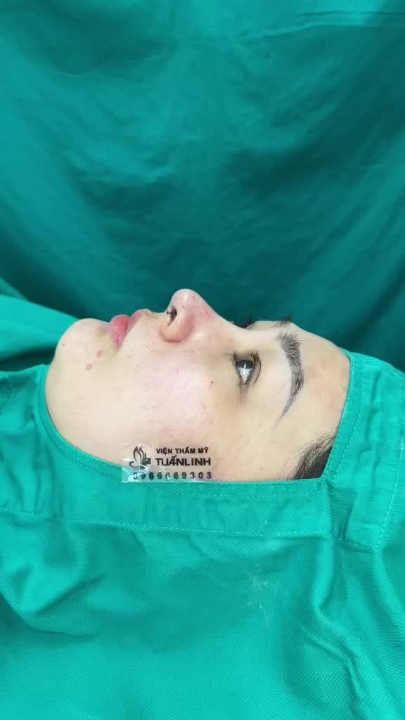 Case Nâng mũi cấu trúc + Ghép cánh mũi!!