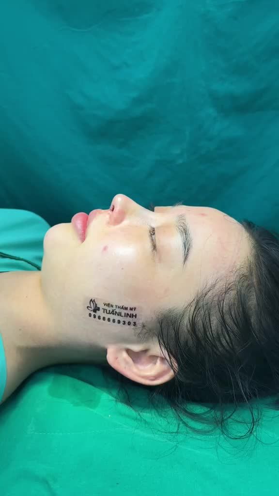 Case Nâng mũi cấu trúc + bọc Megaderm vừa hoàn thành!!