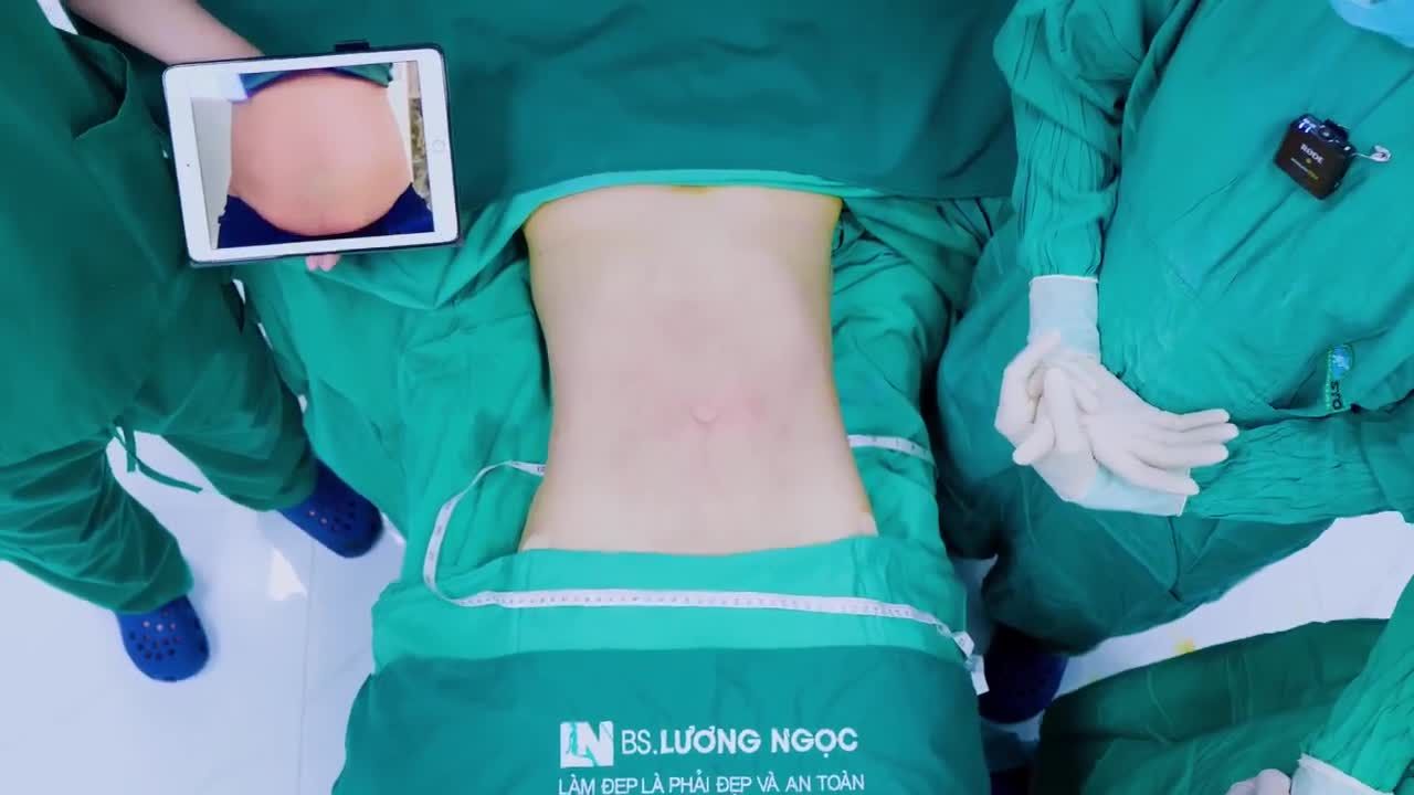 Từng làm "hút mỡ tay, lưng, nách" vài tháng trước và rất ưng ý với kết quả. Chính vì thế, bạn khách hôm nay quyết định quay lại để thực hiện thêm "hút mỡ bụng".