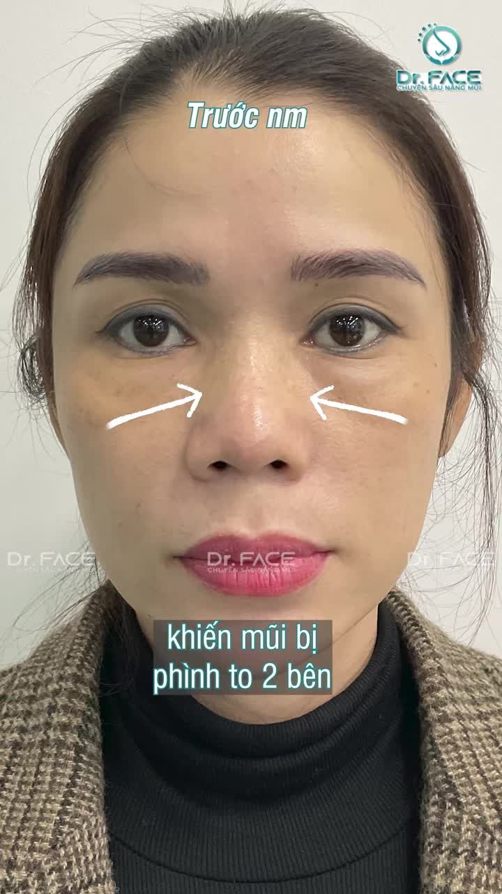 Mũi bị PHÌNH TO do FILLER TRÀN bs ơi!