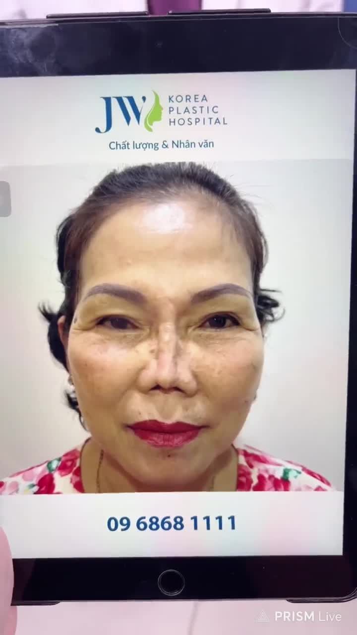 SỐC: Bác sĩ Tú Dung giúp chị khách THOÁT KHỎI chiếc mũi CO RÚT, ĐỨT TRỤ MŨI sau khi thực hiện SỬA MŨI HỎNG