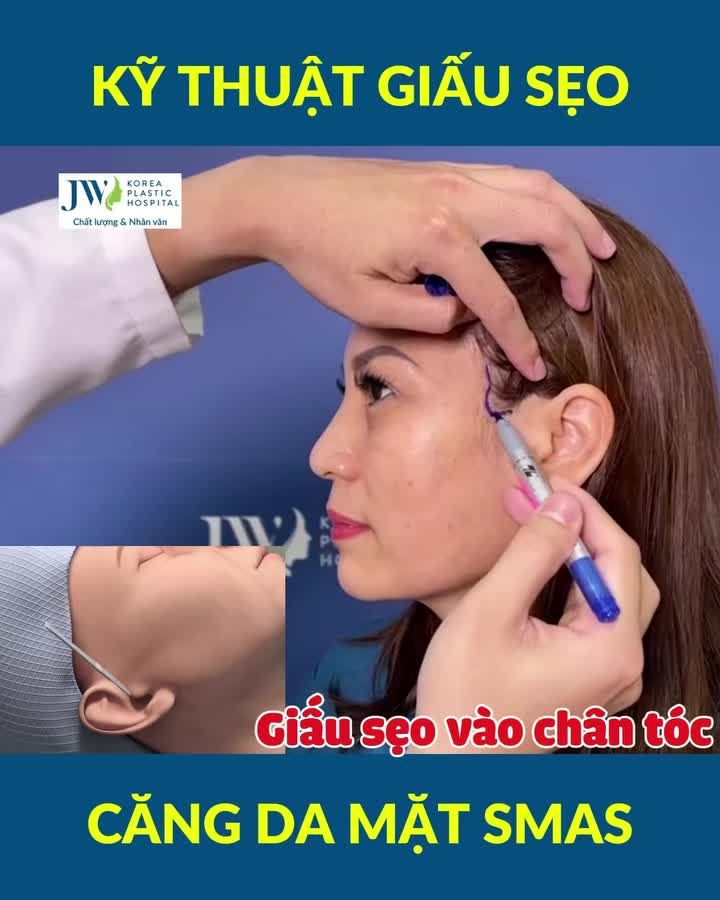 CĂNG DA MẶT SMAS - DUY TRÌ TUỔI THANH XUÂN ĐẾN 10 NĂM