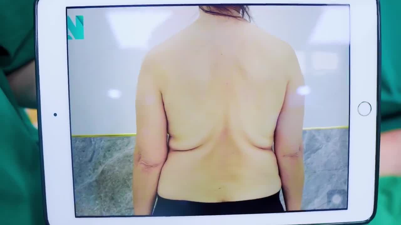 Nhiều năm trước, chị khách đã từng trải qua một ca phẫu thuật “căng cắt da bụng” với mong muốn cải thiện vóc dáng.