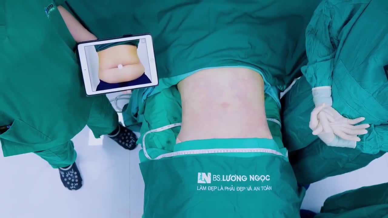 Trước khi làm, bụng chị khách đã chạm mốc 100cm sau hai lần sinh nở, nhất là phần bụng dưới chảy xệ và phình to.
