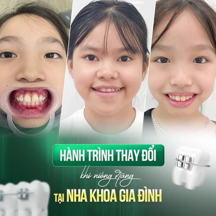 HÀNH TRÌNH NIỀNG RĂNG - MÓN QUÀ TỰ TIN CHO TƯƠNG LAI CỦA CON