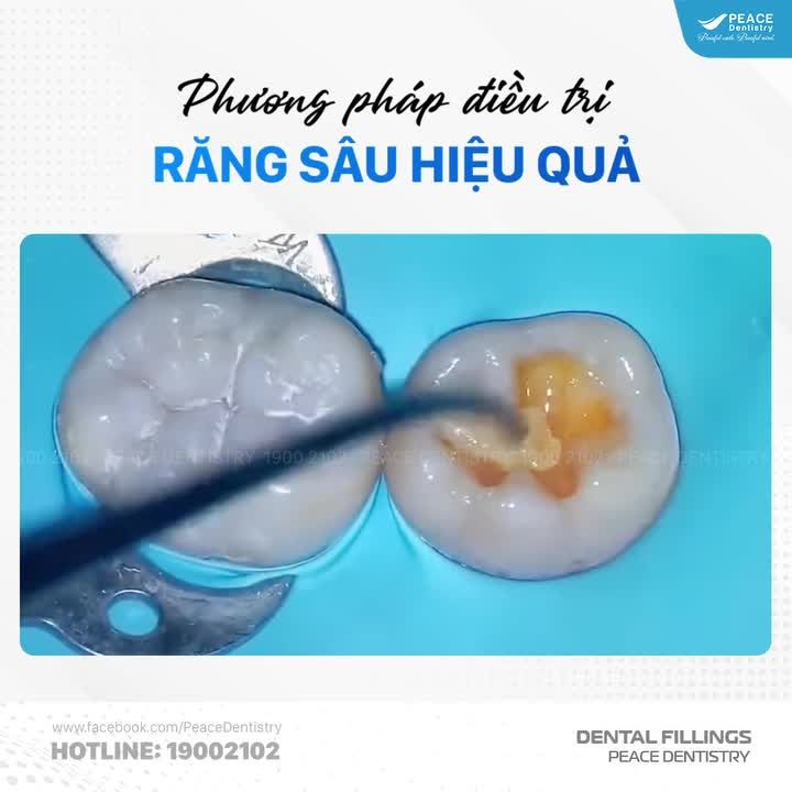 GIẢI PHÁP XỬ LÝ SÂU RĂNG HIỆU QUẢ VÀ TIẾT KIỆM