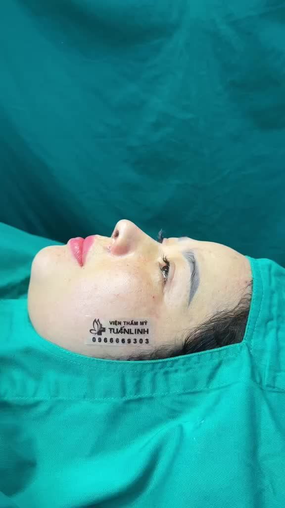 Case nâng mũi cấu trúc + cuộn cánh vừa hoàn thành cho bạn gái đến từ Quảng Ngãi!!