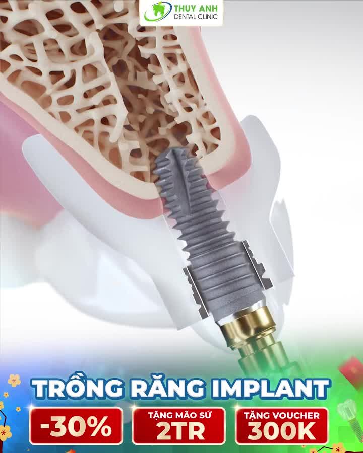 TRỒNG RĂNG SỚM ĂN NGON TRỌN VỊ TẾT CHI PHÍ CHỈ TỪ 6.9TR