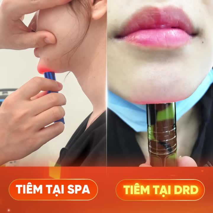 GÓC KIỂM CHỨNG: Sự khác nhau giữa tiêm Filler cằm tại DrD và tiêm tại một cơ sở spa khác.