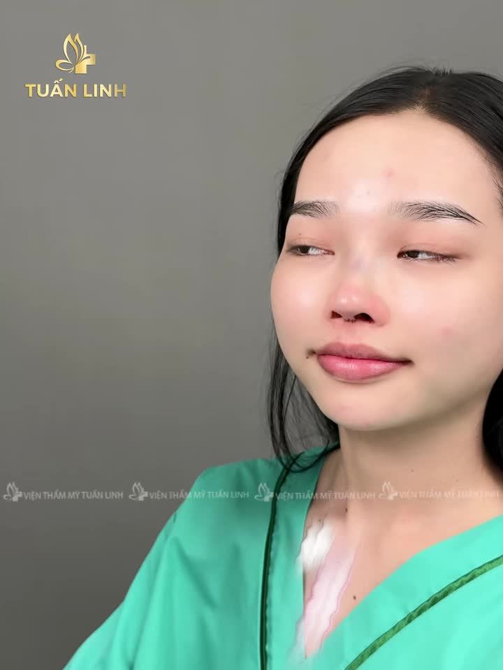 Nếu bạn lo lắng về cảm giác đau khi nâng mũi, hãy tham khảo ngay clip này nha