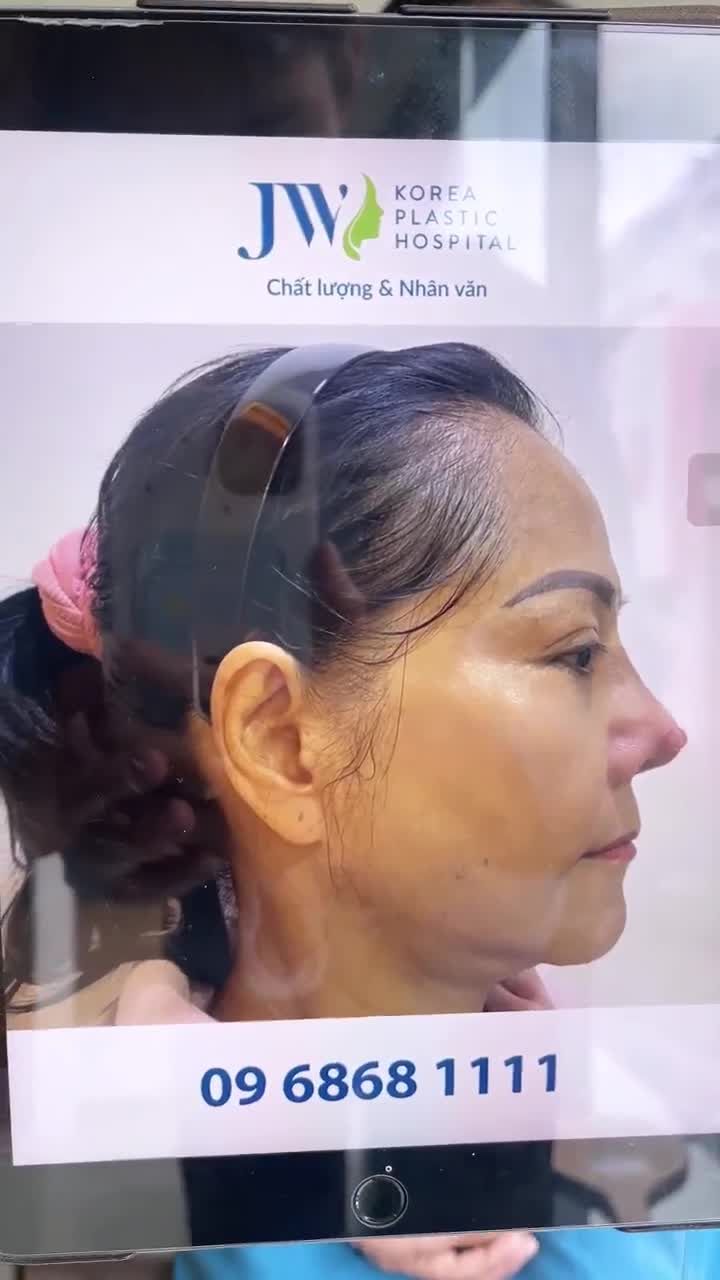 GIẬT MÌNH Quý bà U60 mũi LỘ SÓNG, BÓNG ĐỎ do tin lầm THẨM MỸ CHUI đến Bệnh viện JW RÚT SÓNG MŨI