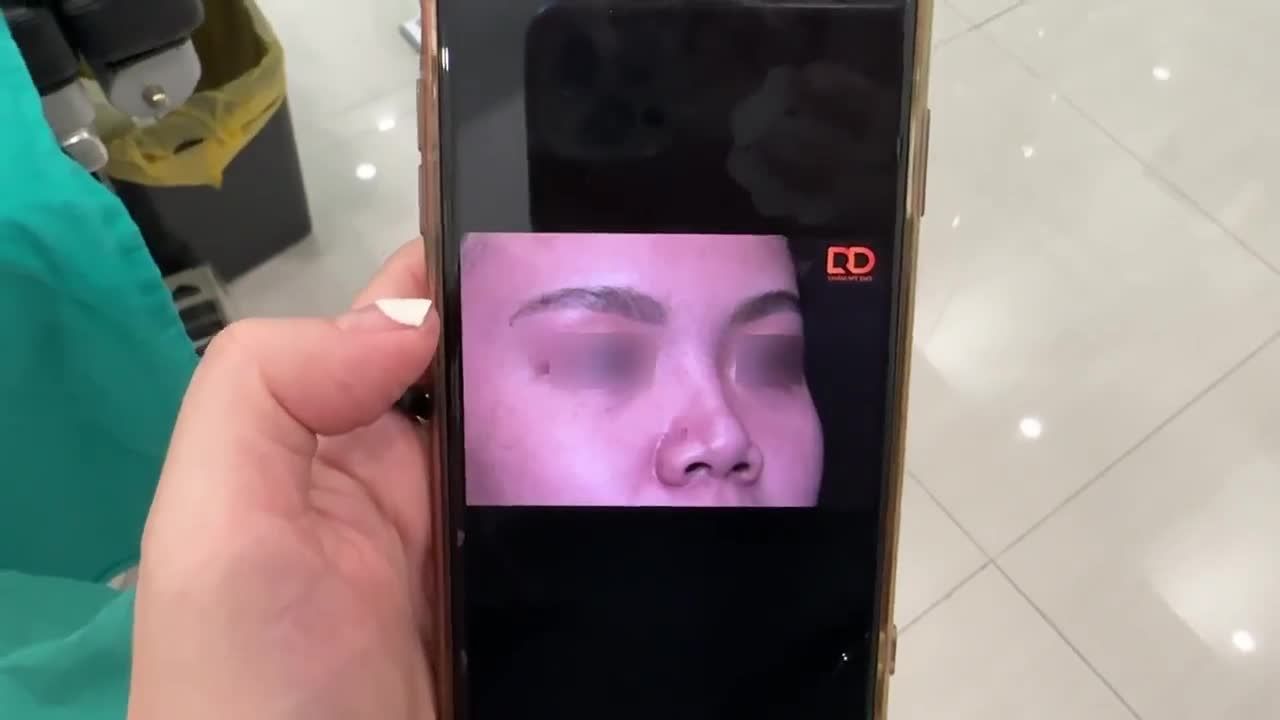 BÁC SĨ ĐIỀN ĐÃ THỰC HIỆN XONG CA TIỂU PHẪU NÂNG MŨI