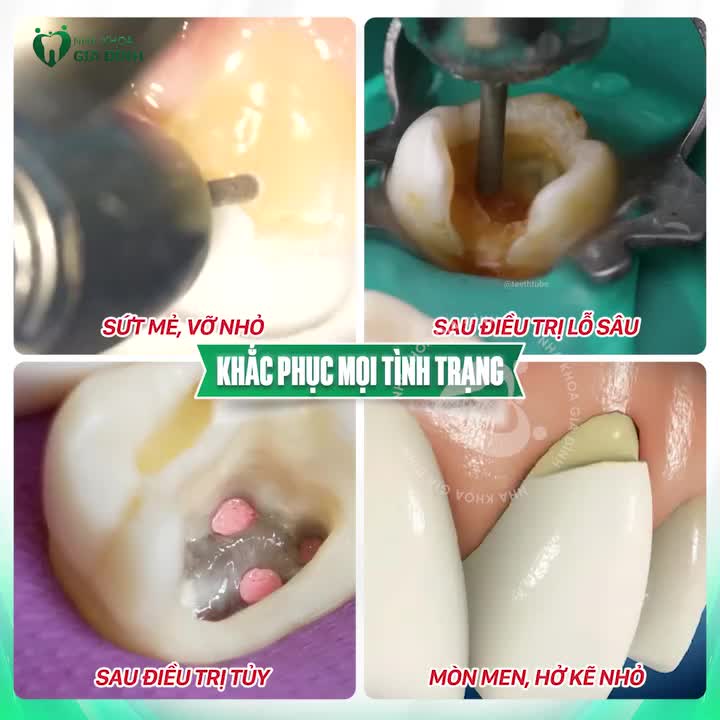 TRÁM RĂNG THẨM MỸ - TẠM BIỆT KHUYẾT ĐIỂM CHO RĂNG