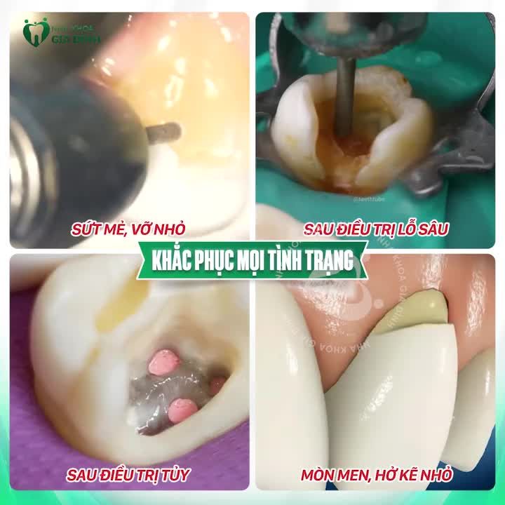 TRÁM RĂNG THẨM MỸ - TẠM BIỆT KHUYẾT ĐIỂM CHO RĂNG