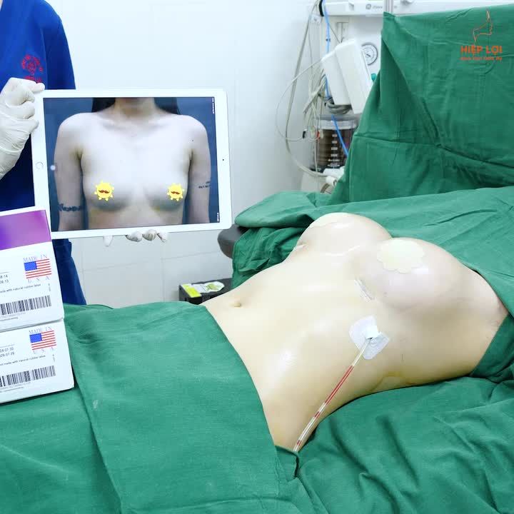 ca nâng ngực: Túi Mentor 300cc cho khách hàng tại Hiệp Lợi