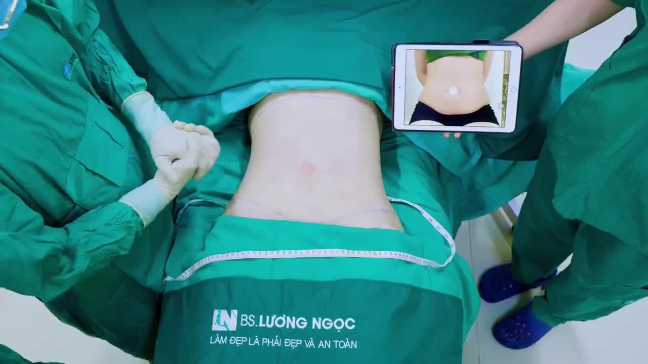 Sáng nay ekip chào đón chị T đến tư vấn dịch vụ hút mỡ.