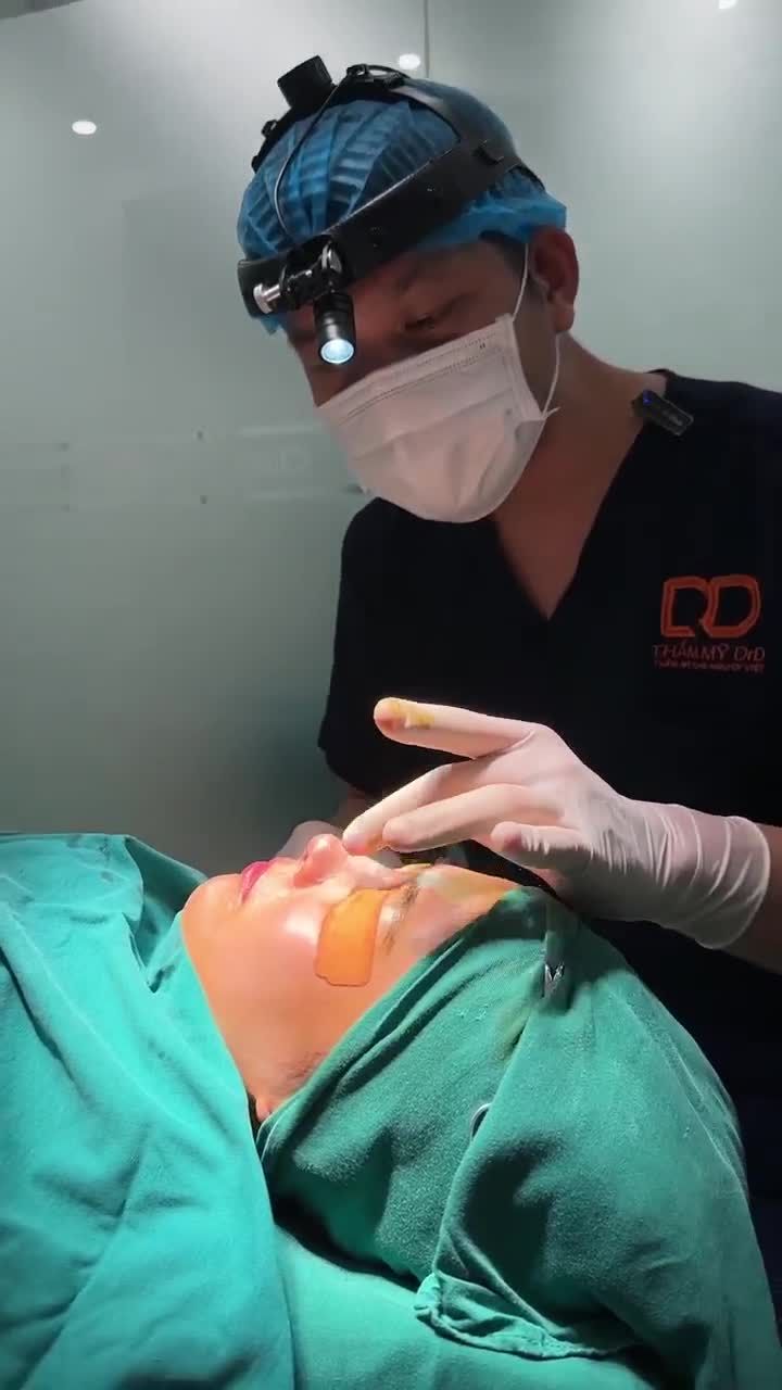 KẾT QUẢ CA SỬA MŨI GỒ CỦA BÁC SĨ LÊ HỮU ĐIỀN