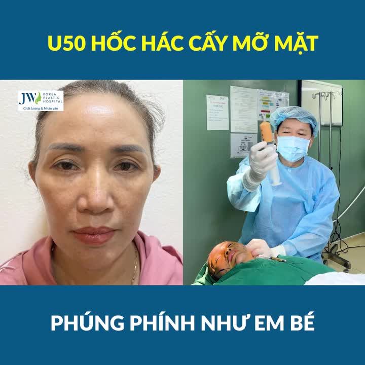 CÔ GÁI THƯ GIÃN suốt 60 phút Bác sĩ Tú Dung CẤY MỠ MẶT Baby Face biến U50 HỐC HÁC hóa MỸ NỮ TƯƠI TRẺ