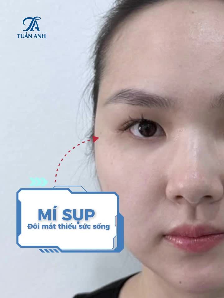 Feedback combo cắt mí trên và mở góc mắt của chị khách hàng tại Thẩm mỹ Tuấn Anh