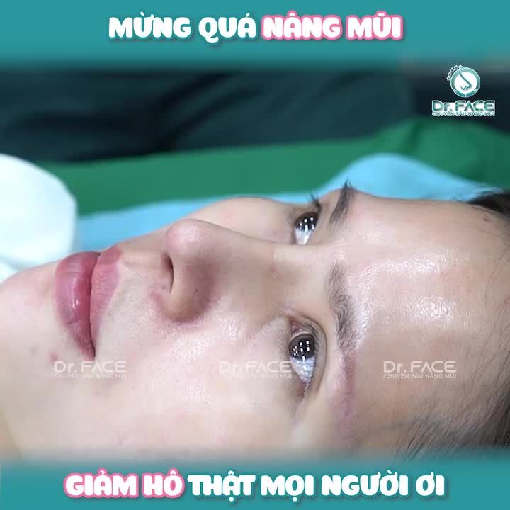 Mừng quá NÂNG MŨI GIẢM HÔ thật mọi người ơi…