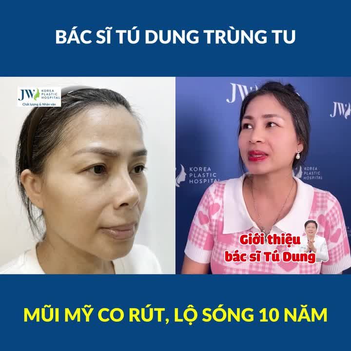 Bác sĩ Tú Dung Nâng mũi TRÙNG TU cứu Việt kiều Mỹ thoát cảnh mũi CO RÚT, LỘ SÓNG 10 năm