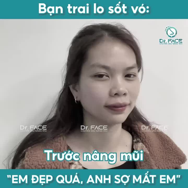 Vốn có chiếc mũi thấp và to bè, bạn ấy muốn thay đổi một chút cho phù hợp, không ngờ làm mũi cấu trúc (sụn Nanoform) xong mới có mấy ngày mà đi đâu ai cũng hết lời khen ngợi.