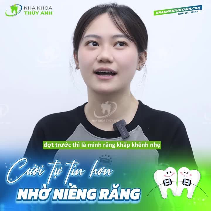 Cùng lắng nghe chia sẻ của bạn ấy trong video dưới đây xem niềng răng tại Thùy Anh đã thay đổi như thế nào và mang đến những cảm xúc ra sao nhé!