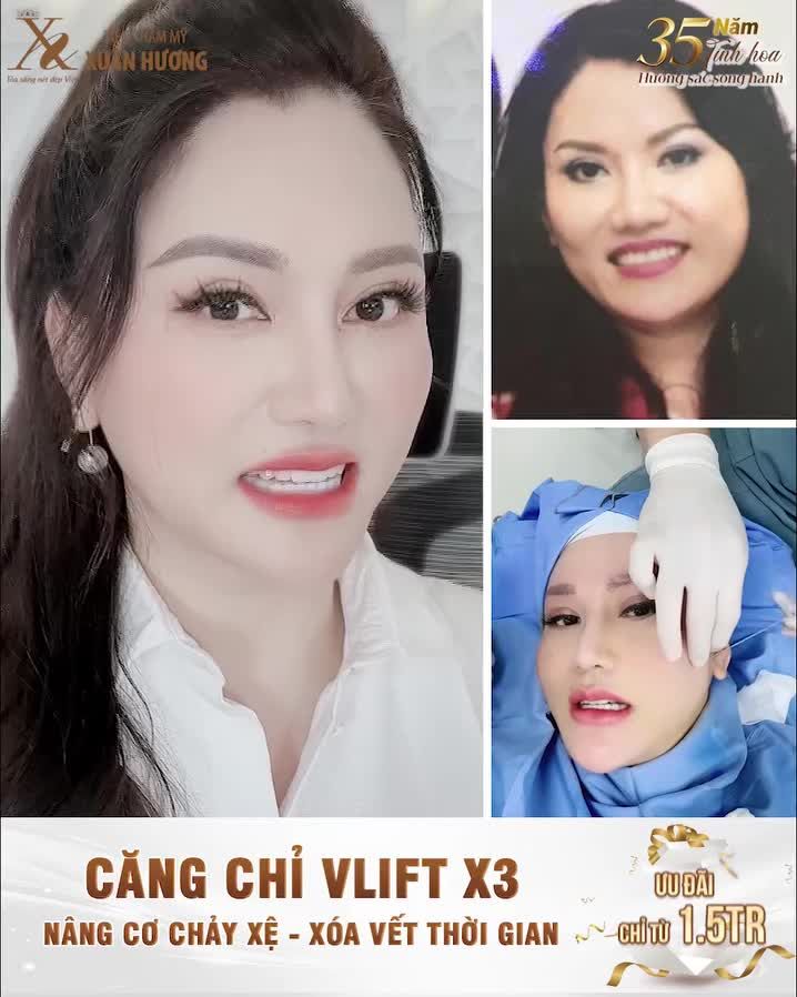 Căng chỉ VLIFT X3 - Nâng cơ chảy xệ, xóa vết thời gian